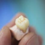 expat-dental-cracked-teeth-crowns