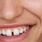 Diastema gab between your teeth expat dental